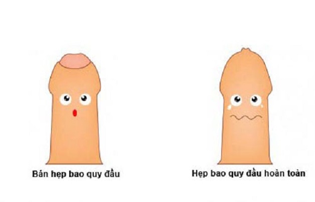 Phân biệt bán hẹp bao quy đầu và hẹp bao quy đầu